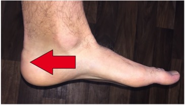 Kaj je Haglundova deformacija oziroma retrokalkanealna eksostoza in možnosti terapije